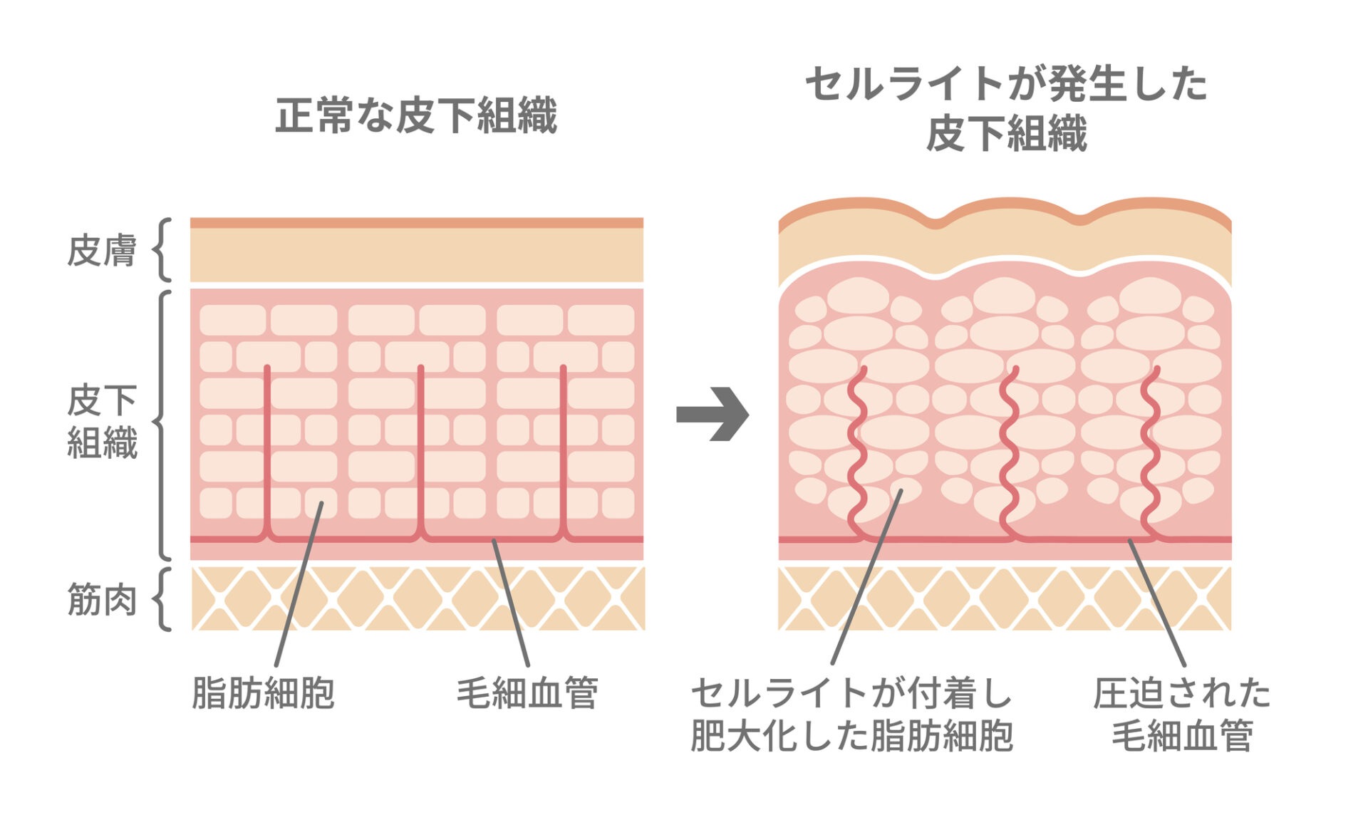 セルライトは脂肪細胞が大きくなったことによる肌の表面の凹凸を指す